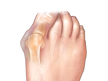 Load image into Gallery viewer, Generise Bunion Exerciser